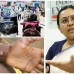 കേരളത്തിൽ എം പോക്സ് സ്ഥിരീകരിച്ചു; മലപ്പുറം സ്വദേശിക്ക് രോഗം